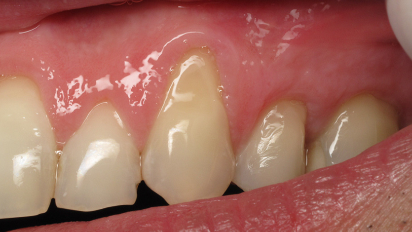 Receding-gums-causes-treatment